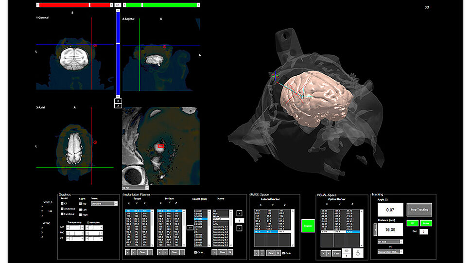 cortExplore -3-D Gehirn-Darstellung eines Patienten
